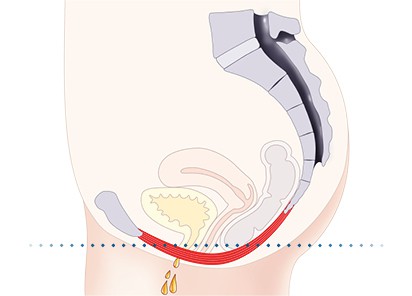 Pelvic-Floor Muscle Repair 5 Pelvic floor muscles Rhyl