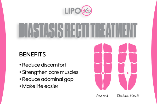 Revolutionising Muscle Repair: The Power of LIPO360 Body Sculpt Post-Injury 5 diastasis recti treatment Rhyl