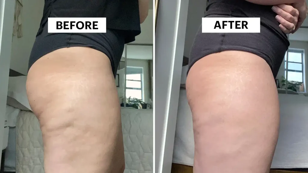 Sculpting Your Bum: Can Toning Exercises Really Reduce Cellulite? 1 Do Toning Exercise Rhyl Really Tackle Cellulite?