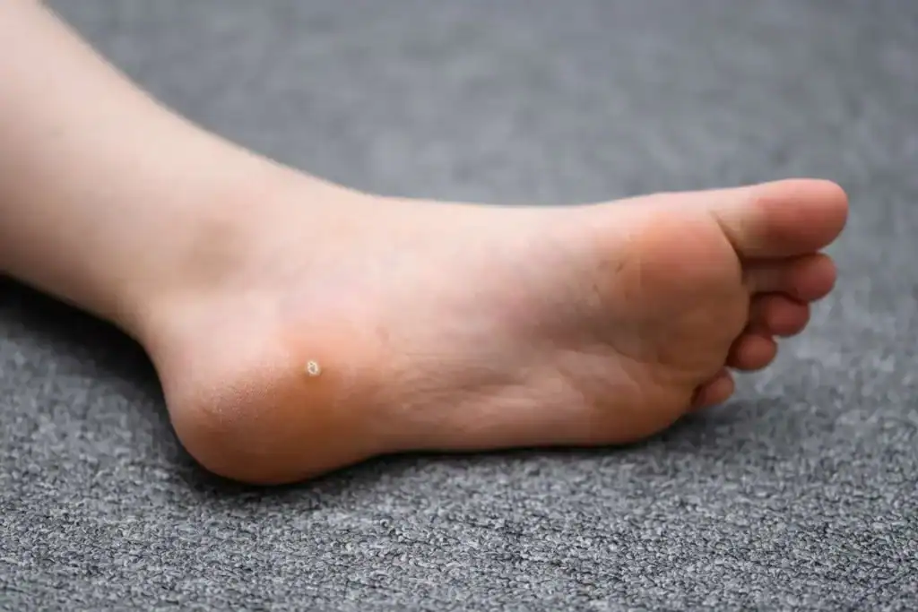 Cryotherapy For Warts And Also Verrucas 2 Image of verruca on the bottom of the foot that able to be treated with Cryotherapy Rhyl