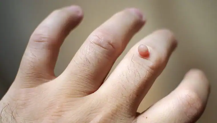 Cryotherapy For Warts And Also Verrucas 1 Image of blemish that Cryotherapy Rhyl can remove with Lipo 360.