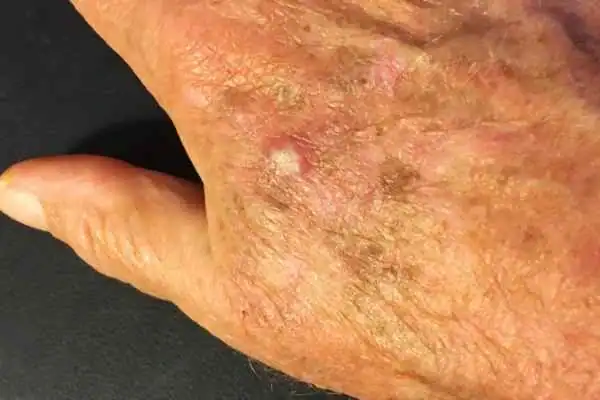 Cryopen For Actinic Keratoses 1 Image of Actinic keratoses Rhyl on a person hand