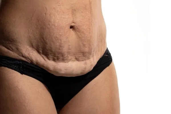 The Science of Skin Tightening 1 The science behind skin tightening Rhyl picture of a woman's sagging skin on the stomach
